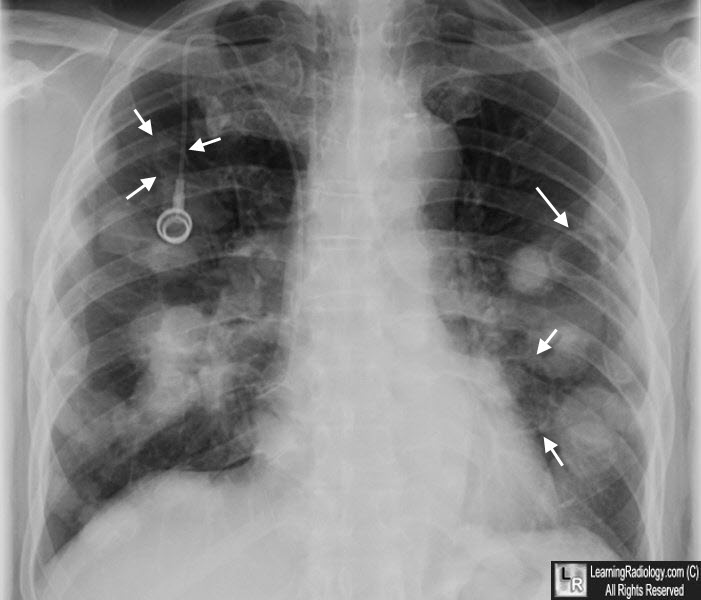 cavitary lung metastases