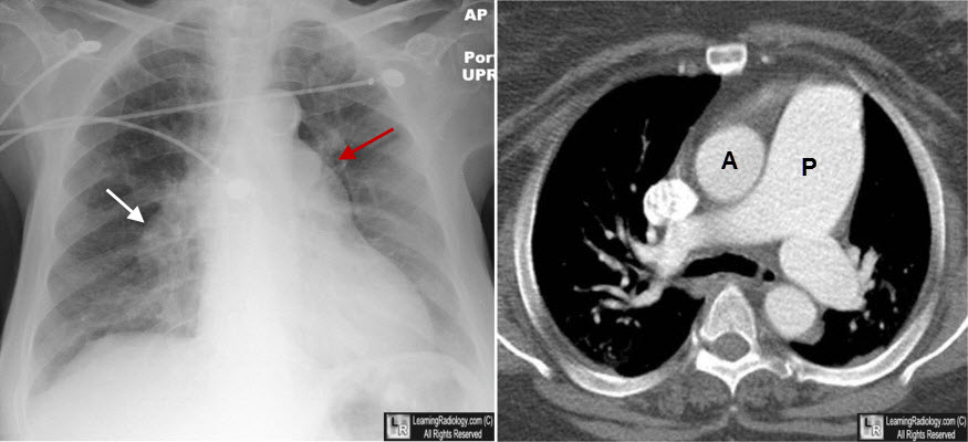 pulmonary arterial hypertension, pah