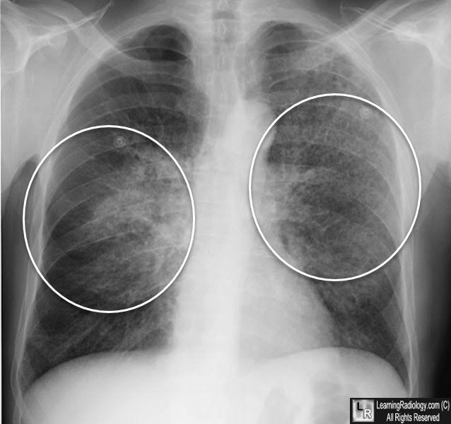 Pneumocystis Pneumonia