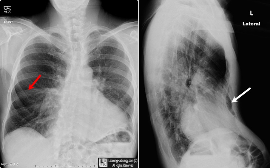 Pectus Excavatum Deformity