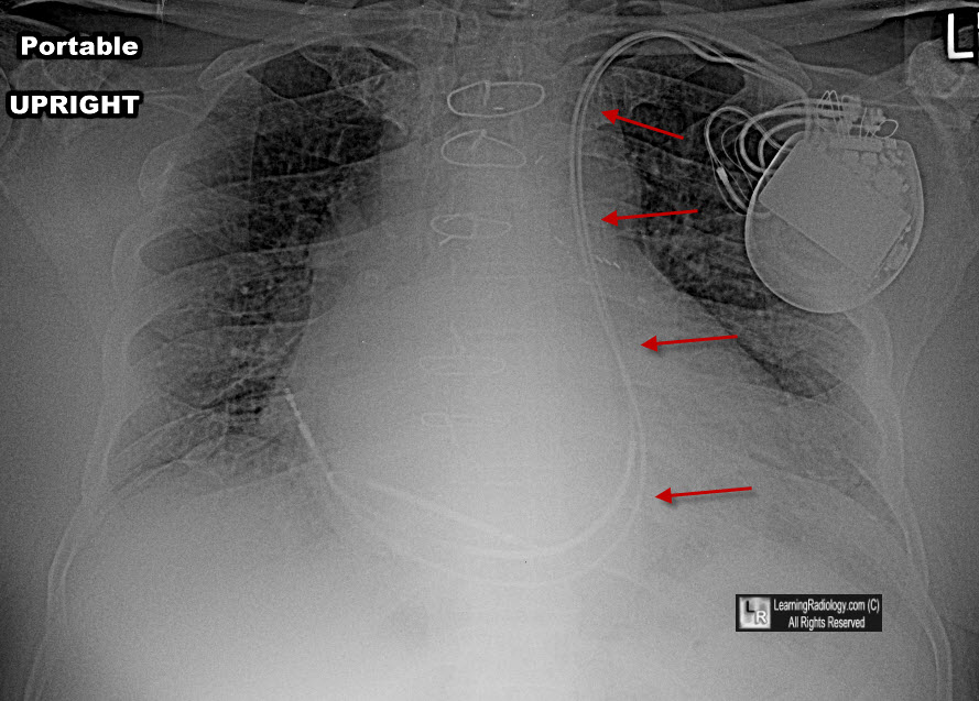 Where does the superior vena cava empty?