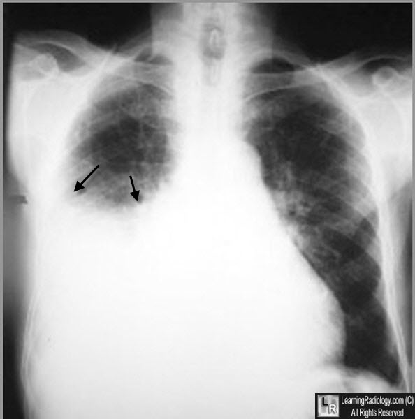 pleural effusion