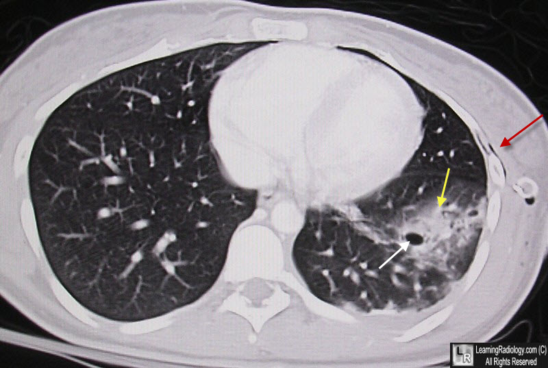 Pulmonary laceration