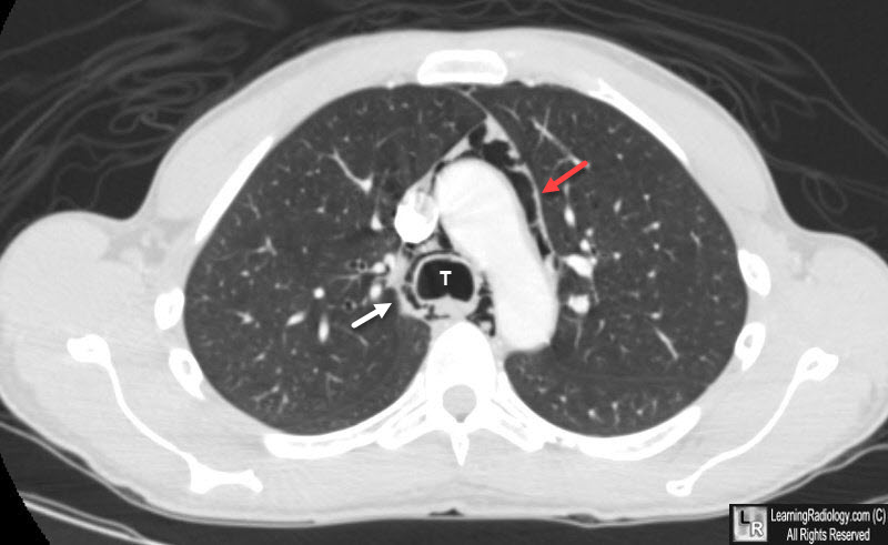 Pneumomediastinum