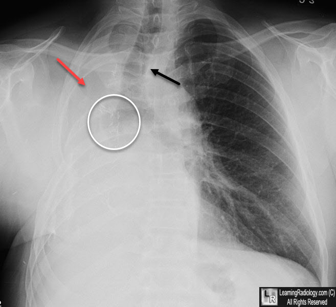 Post pneumonectomy