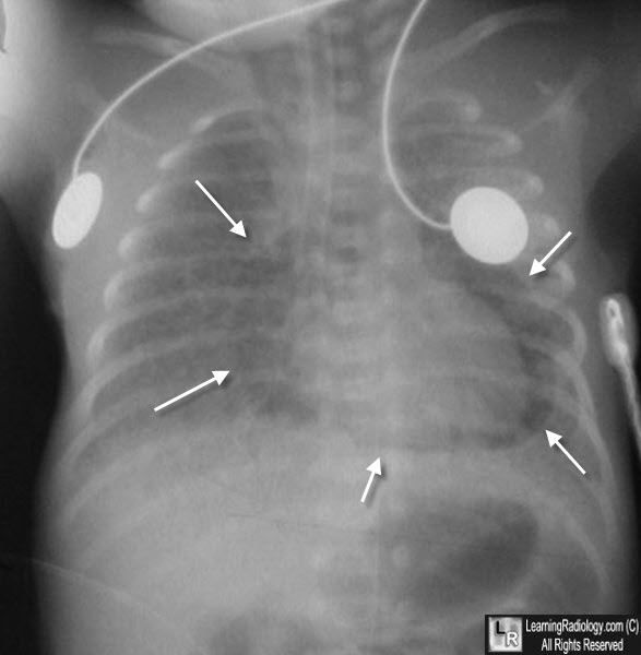 Pneumopericardium