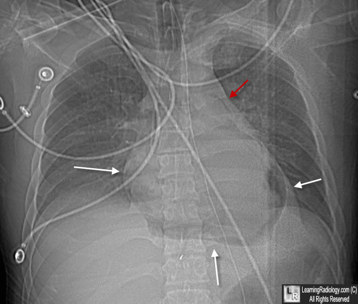 pneumopericardium