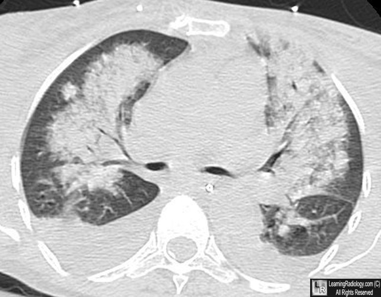 Pulmonary Alveolar Edema