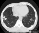 Rheumatoid Nodules