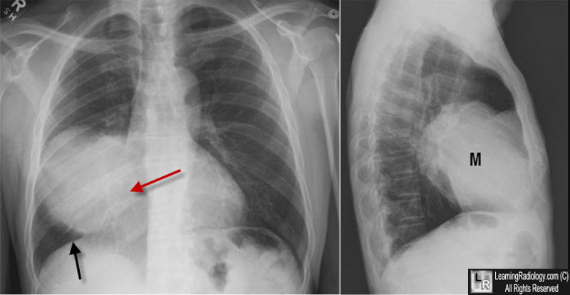 Silhouette Sign, Right Middle Lobe Mass