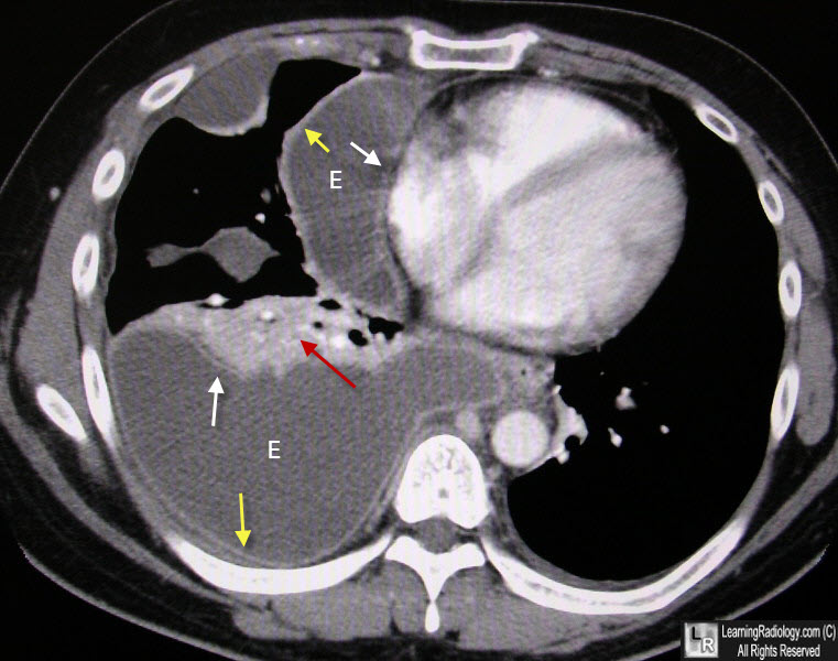 Split Pleura Sign of Empyema