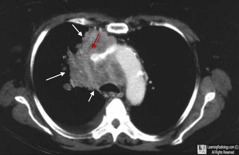 Superior vena Caval Obstruction