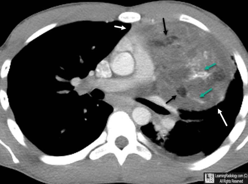 Mediastinal Teratoma