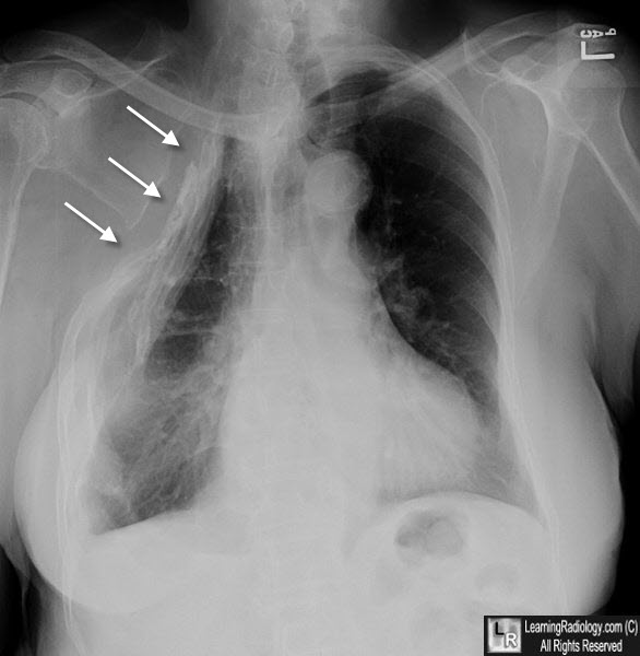 thoracoplasty