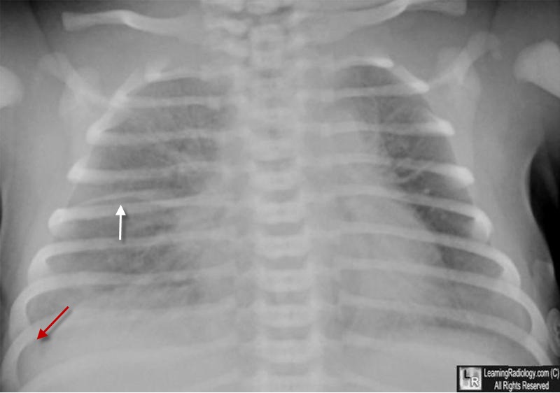 ttn, transient tachypnea of newborn