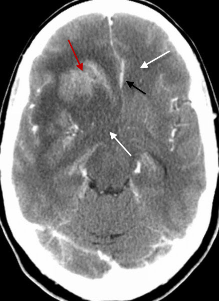 Glioblastoma Multiforme