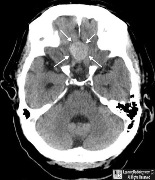 Meningioma