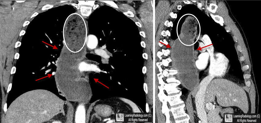 achalasia