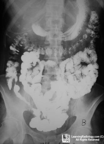 crohn disease