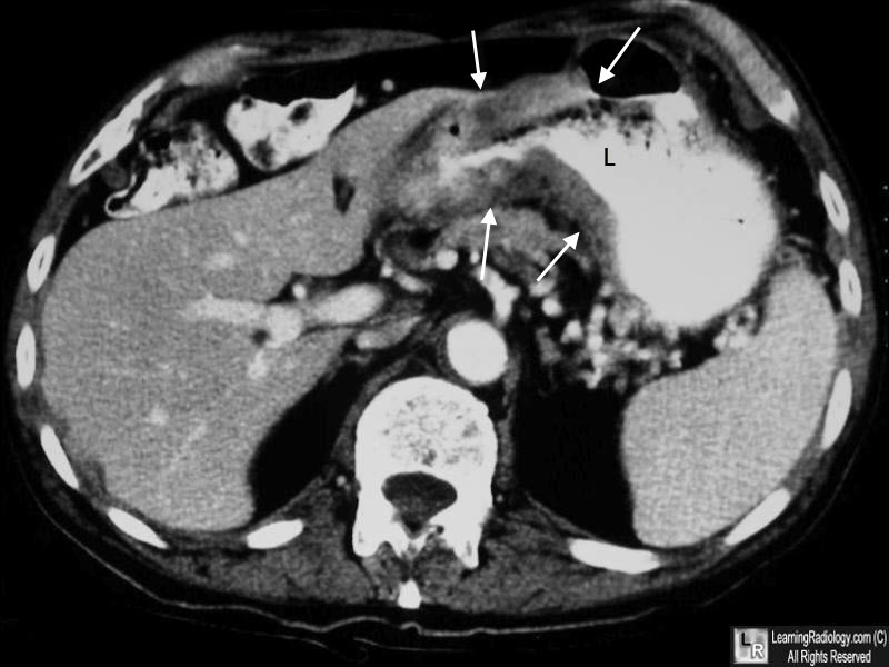 gastric cancer ct scan calea 7 nemathelminthes gilig