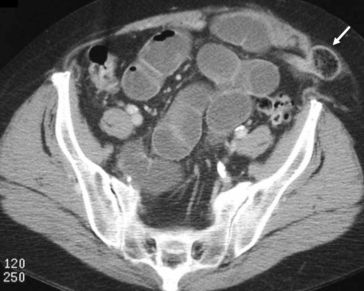 Spigelian hernia