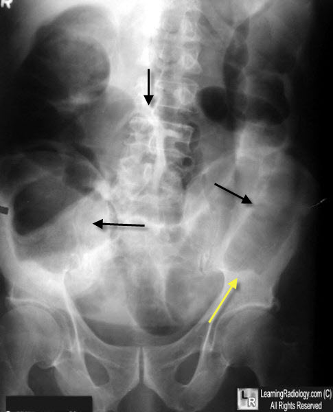 large bowel obstruction