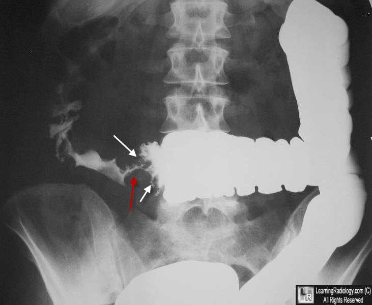 Cancer colorectal barium enema.