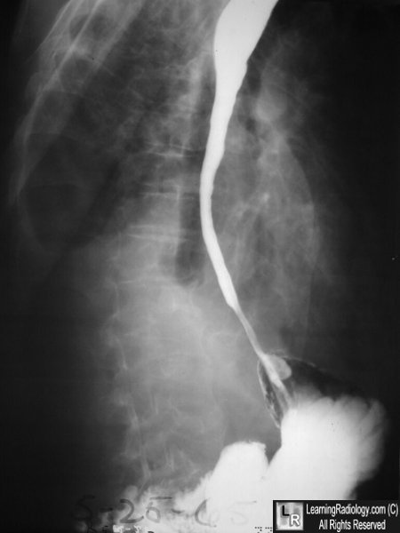 Caustic Esophagitis