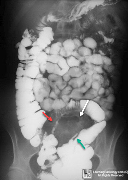 Crohn Disease