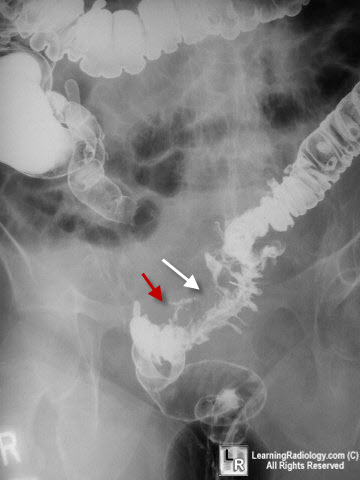 diverticulitis