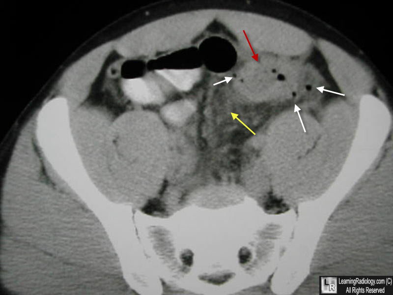 diverticulitis