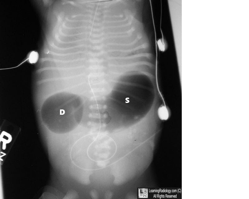 Bouble Bubble Sign, duodenal atresia