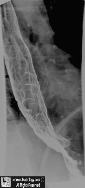 Esophageal varices