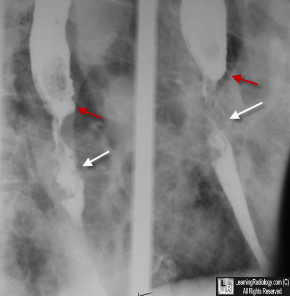 esophagus carcinoma esophageal