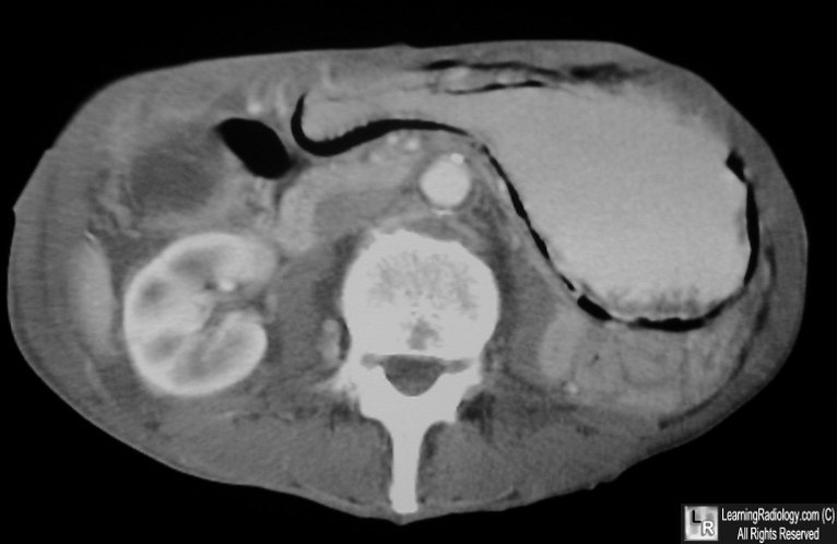 gastric emphysema