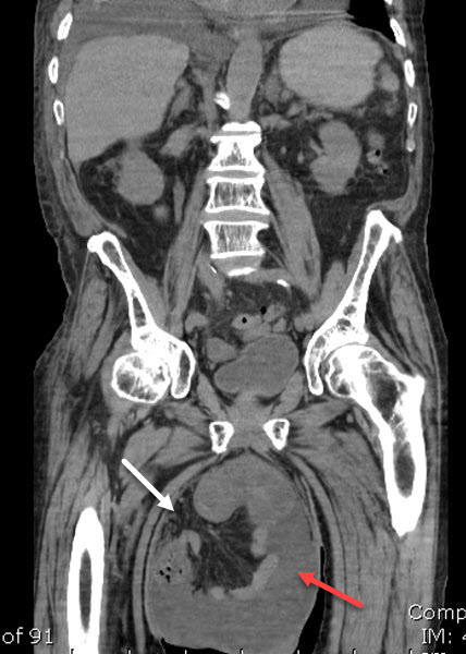 Indirect inguinal hernia