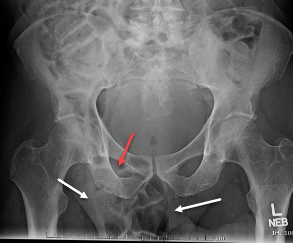Inguinal Hernia