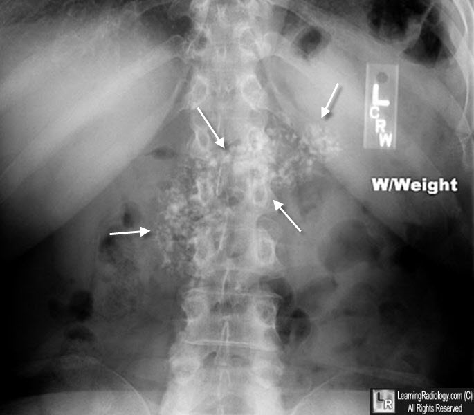 Chronic Pancreatitis