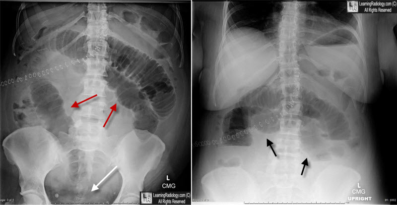 sbo, small bowel obstruction