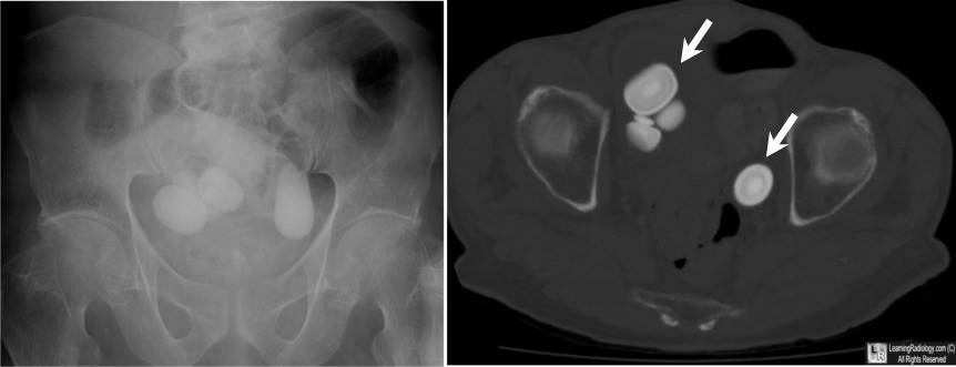 Bladder Calculi