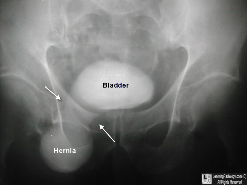 bladder hernia