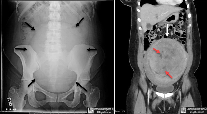 Uterine Fibroids