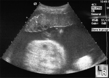 LearningRadiology - Placental Grading