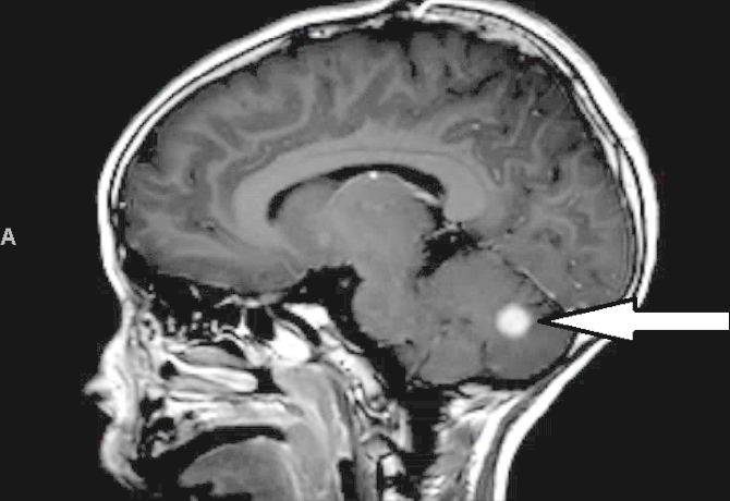 Cerebellar Pilocytic Astrocytoma