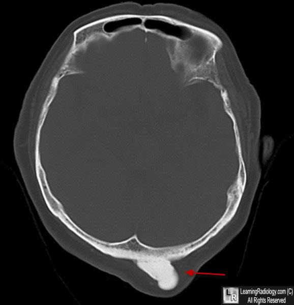 Osteoma of the Skull