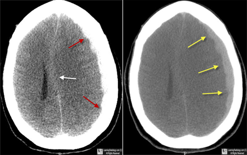 subdural hematoma