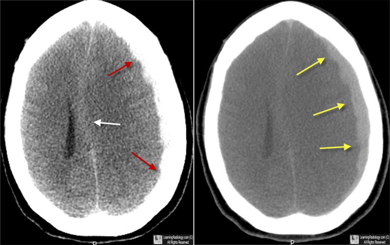 Learning Radiology Subdural Hematoma