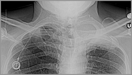 pleural fissure thickening