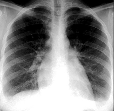 Acute interstitial pneumonitis steroids