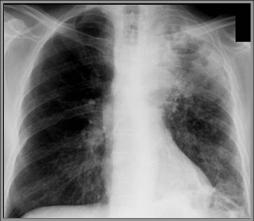 Как лечить klebsiella pneumoniae во влагалище Как лечить klebsiella pneumoniae во влагалище